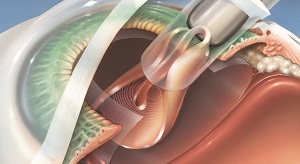 Имплантация ИОЛ в афакичный глаз