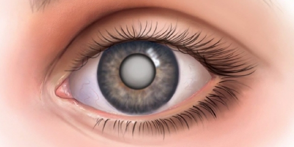 Микрохирургия катаракты: что необходимо знать.