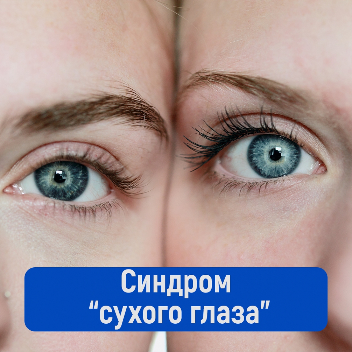 Синдромом «сухого глаза»